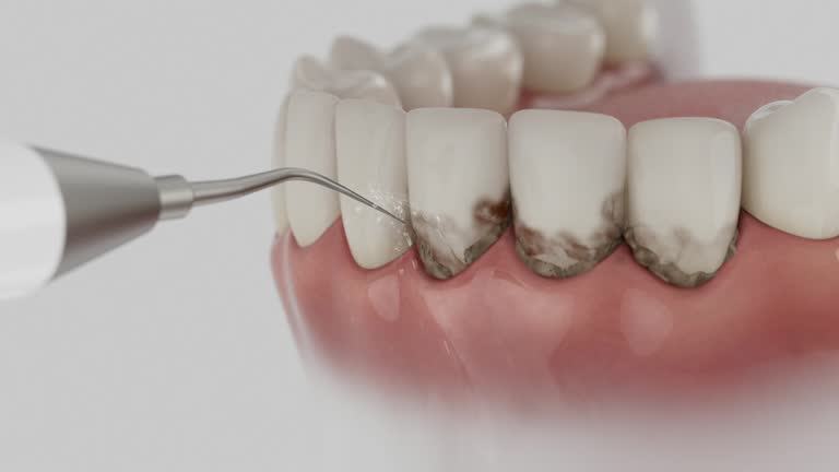 Trusted Dental Implants service in Koontz Lake, IN - Dentist Open Now